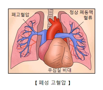 폐성 고혈압