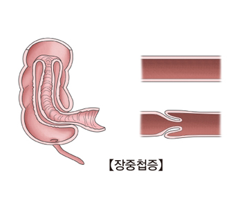 장중첩증