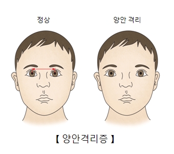 양안격리증