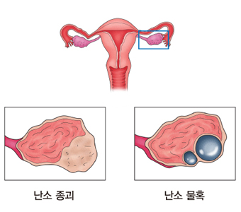 난소의 양성 종양