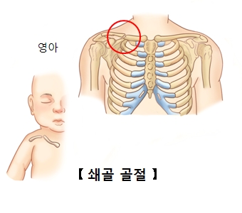 쇄골 골절