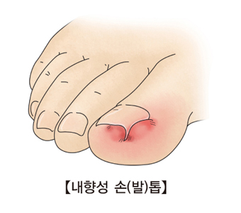 내향성 손발톱