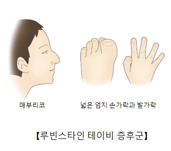 루빈스타인 테이비 증후군