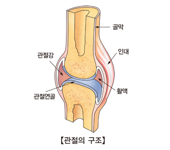 류마티스 관절염