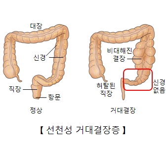 선천성거대결장증