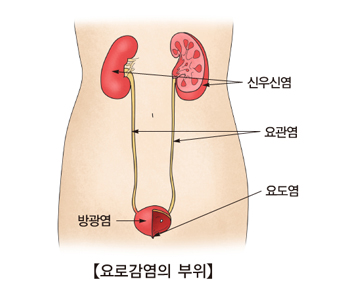 요로감염