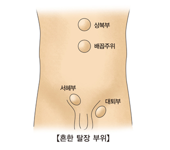 재발성 탈장