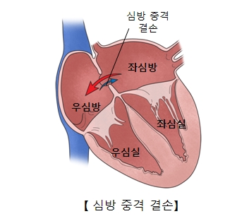 심방중격결손