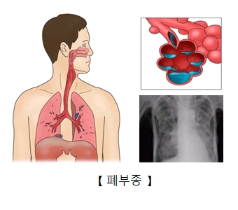 폐부종