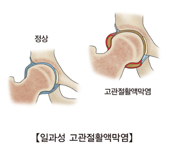 일과성고관절활액막염