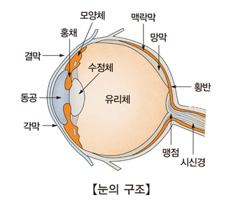 각막 궤양