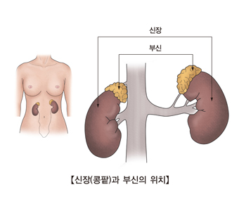 부신암