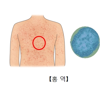 홍역