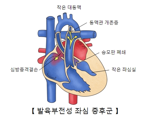 발육부전성 좌심 증후군