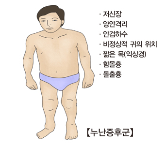 누난 증후군