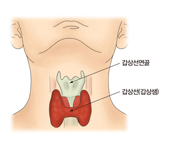 갑상선수질암