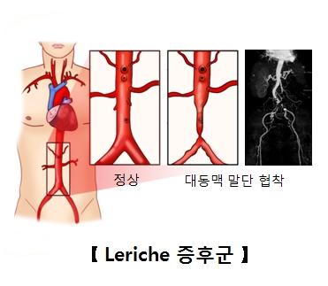 Leriche 증후군